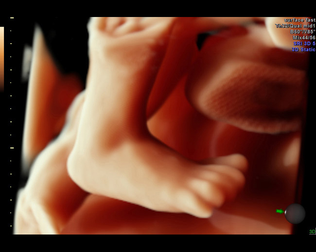 Hdlive-33-week-fetus