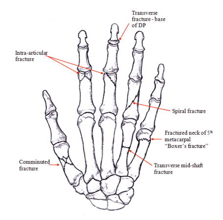 Hand-fracture1_medium
